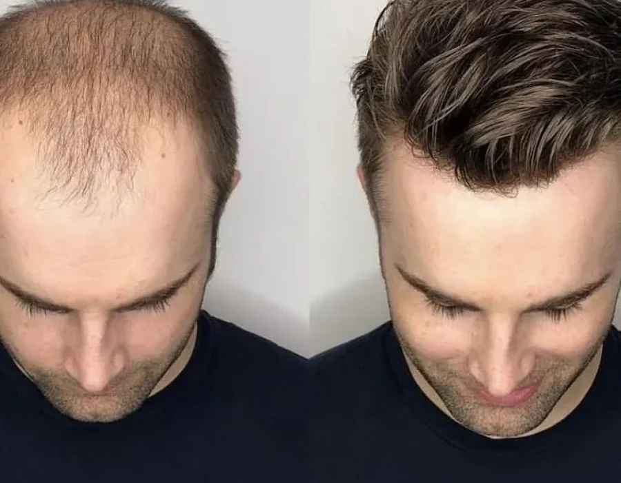 Men's Hair Replacement System Giving You a Better Look _Men‘s Wig for Hair Loss